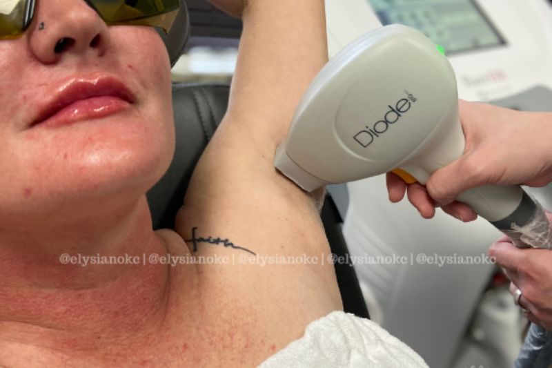 WHICH AREAS CAN I TREAT WITH BAREHR™?​